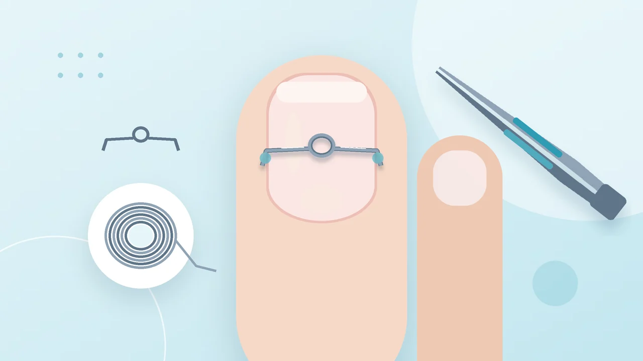 Tracking nail correction braces from visit to visit